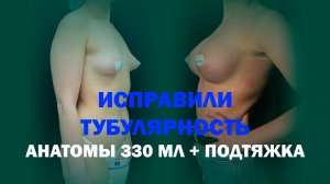 Увеличение груди с коррекцией тубулярности и циркулярной подтяжкой у Волкова