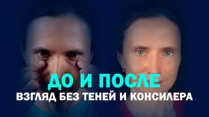 Расширенная нижняя блефаропластика с миопексией: мягкий переход вместо слезной борозды