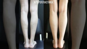 Круропластика - контурная пластика голеней с использованием икроножных имплантов