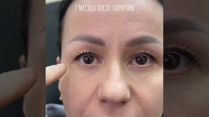 Нижняя блефаропластика