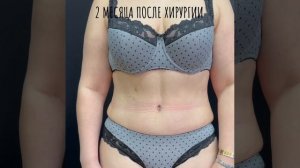 Липоабдоминопластика