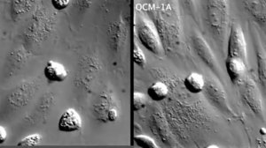 Клетки увеальной меланомы используют новый путь трансэндотелиальной миграции