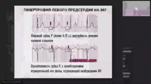 Электрическая ось и гипертрофии отделов сердца