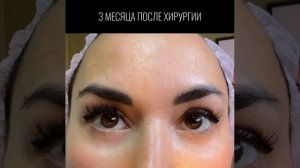 Одномоментная блефаропластика