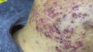 Relax Spa 003 • АСМР • Sac Dep Spa collection • acne