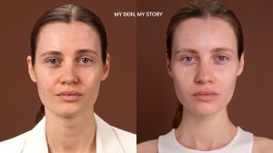 BABOR_MY SKIN, MY STORY: Уход при акне, постакне и расширенных порах — Валерия