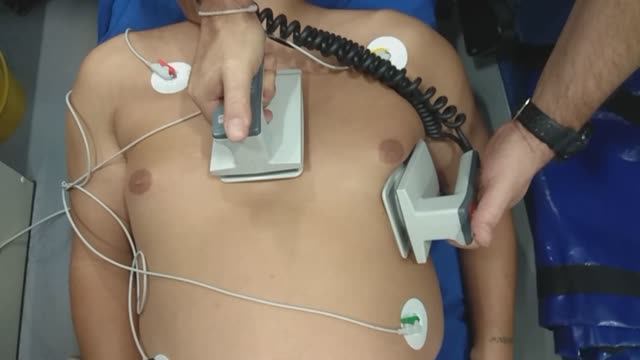 Кардиоверсия. мониторинг экг. Дефибриллятор АКСИОН ДКИ-Н-11 смотреть онлайн