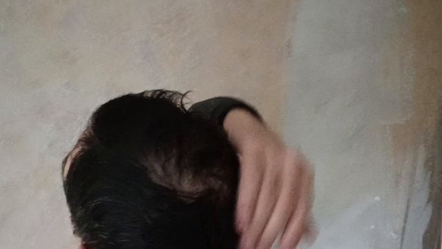 Восстановление после пересадки волос. Семь месяцев!