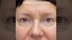 Нижняя блефаропластика
