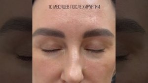 Нижняя блефаропластика + импланты