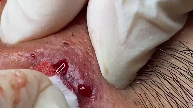 Relax Spa  001  ASMR  Sac Dep Spa collection  acne