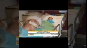 Ампутировали половину мозга