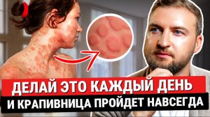 Одно простое действие и крапивница больше никогда не вернется