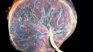 Преждевременное отслоение плаценты