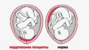 Что такое предлежание плаценты