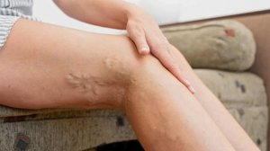 Варикозное расширение вен при беременности