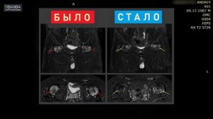 Фаза №1 восстановления суставов от асептического некроза. Отёк костного мозга на МРТ проходит