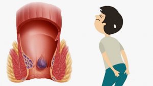 Геморрой во время беременности