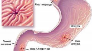 Аппарат Импловит «Катушка Мишина»при заболеваниях ЖКТ. Язва желудка, двенадцатиперстной кишки