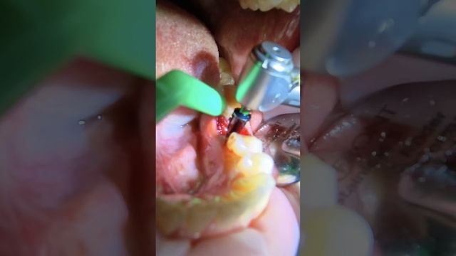 Удаление зуба и одномоментная имплантация