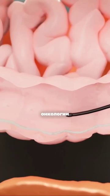 Колоноскопия - одно из самых важных эндоскопических исследований