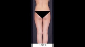 РУЧНАЯ ПЛАСТИКА ТЕЛА NEWBODYKA. КОРРЕКЦИЯ ФИГУРЫ. КАЛИНИН АЛЕКСЕЙ. РЕЗУЛЬТАТ ДО И ПОСЛЕ. ВИДЕО 3(1)