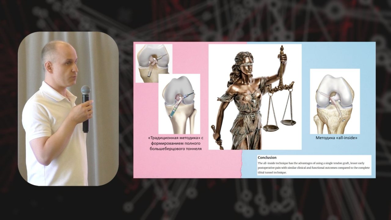Пластика передней крестообразной связки. Почему не all-inside?