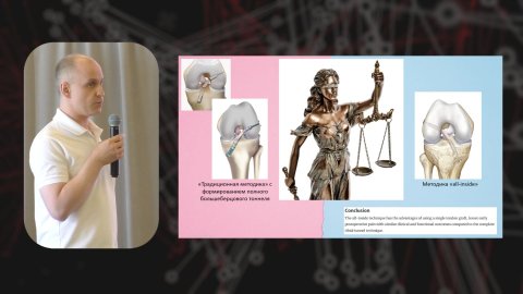 Пластика передней крестообразной связки. Почему не all-inside?