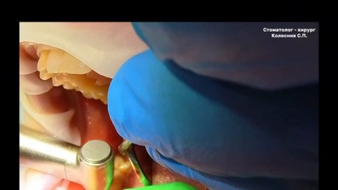 Удаление анкилозированного (резорциненного) зуба