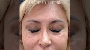 Эндоскопический лобно-височный лифтинг