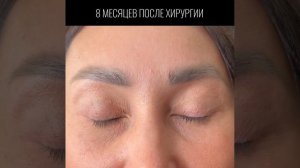 Лобно-височный лифтинг+блефаропластика