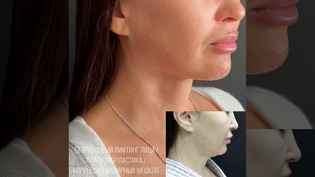Безрубцовый лифтинг лица, платизмопластика, нижняя расширенная блефаропластика