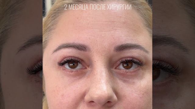 Блефаропластика