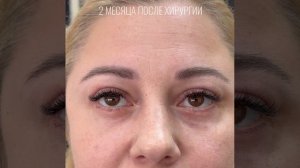 Блефаропластика