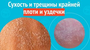 😧 Сухость и трещины крайней плоти и уздечки. Клинический случай №1539