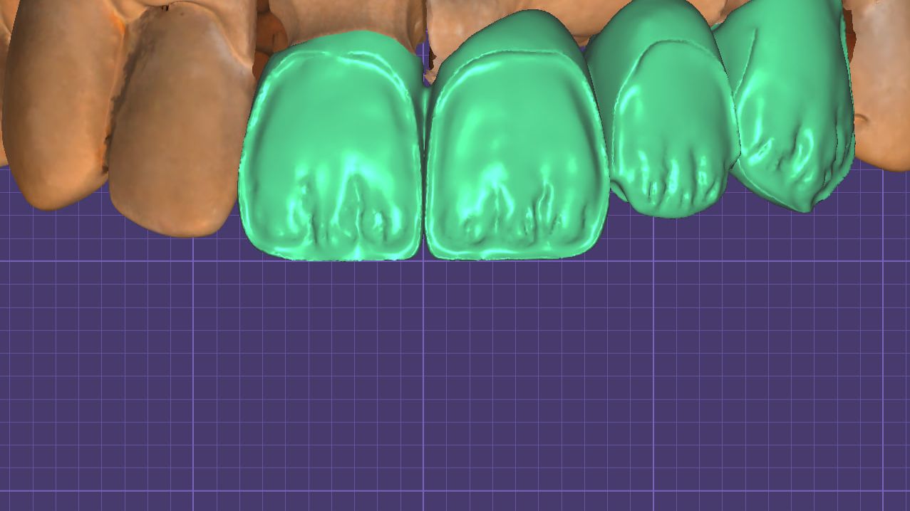 Мамелоны в Exocad.