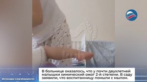 Маленькая девочка вернулась домой из детского сада в Адлере с термическим ожогом и попала в больницу