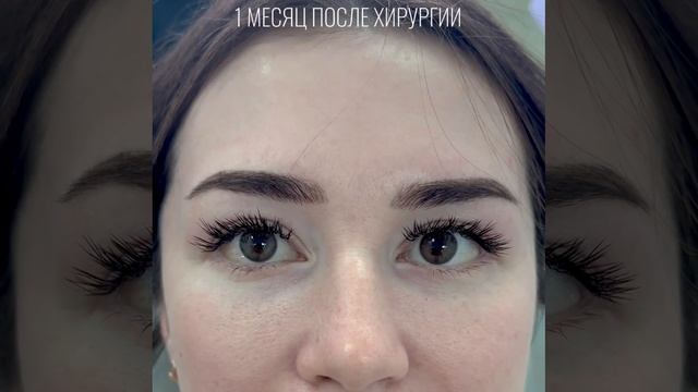 Нижняя блефаропластика