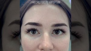 Нижняя блефаропластика