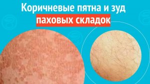 ⏩ Коричневые пятна и зуд паховых складок. Клинический случай №1537