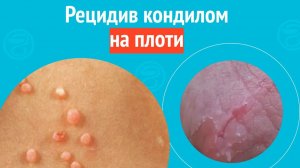🥺 Рецидив кондилом на плоти. Клинический случай №1538