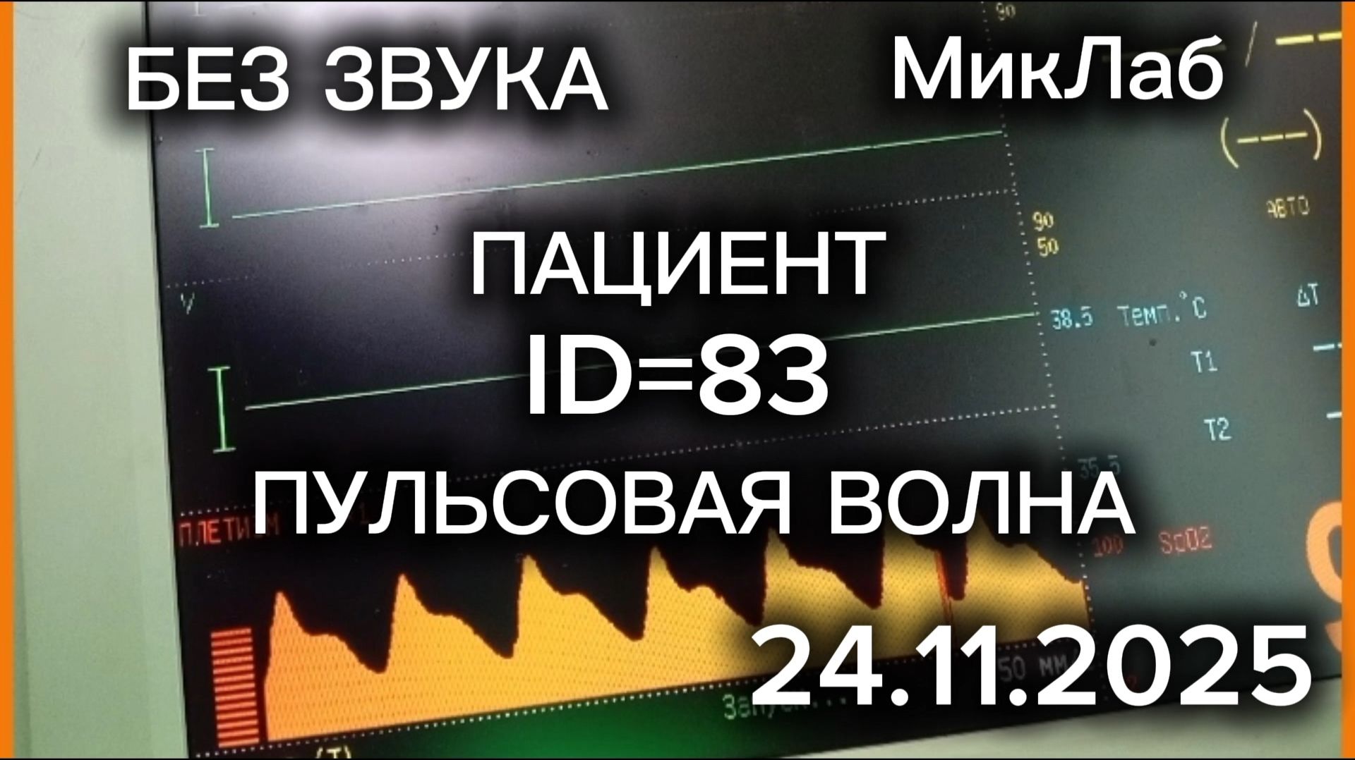Пациент ID=83. Пульсовая волна. Без звука. Доктор Микулин. 24.11.2025. МикЛаб