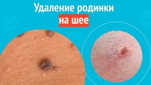 ✅ Удаление родинки на шее. Клинический случай №1533