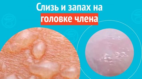 🙄 Слизь и запах на головке члена. Клинический случай №1536