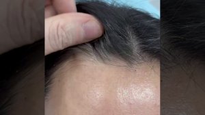 Эндоскопический лифинг 2