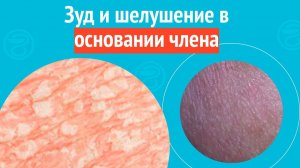😒 Зуд и шелушение в основании члена. Клинический случай №1534