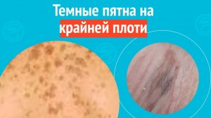 🙄 Темные пятна на крайней плоти. Клинический случай №1548