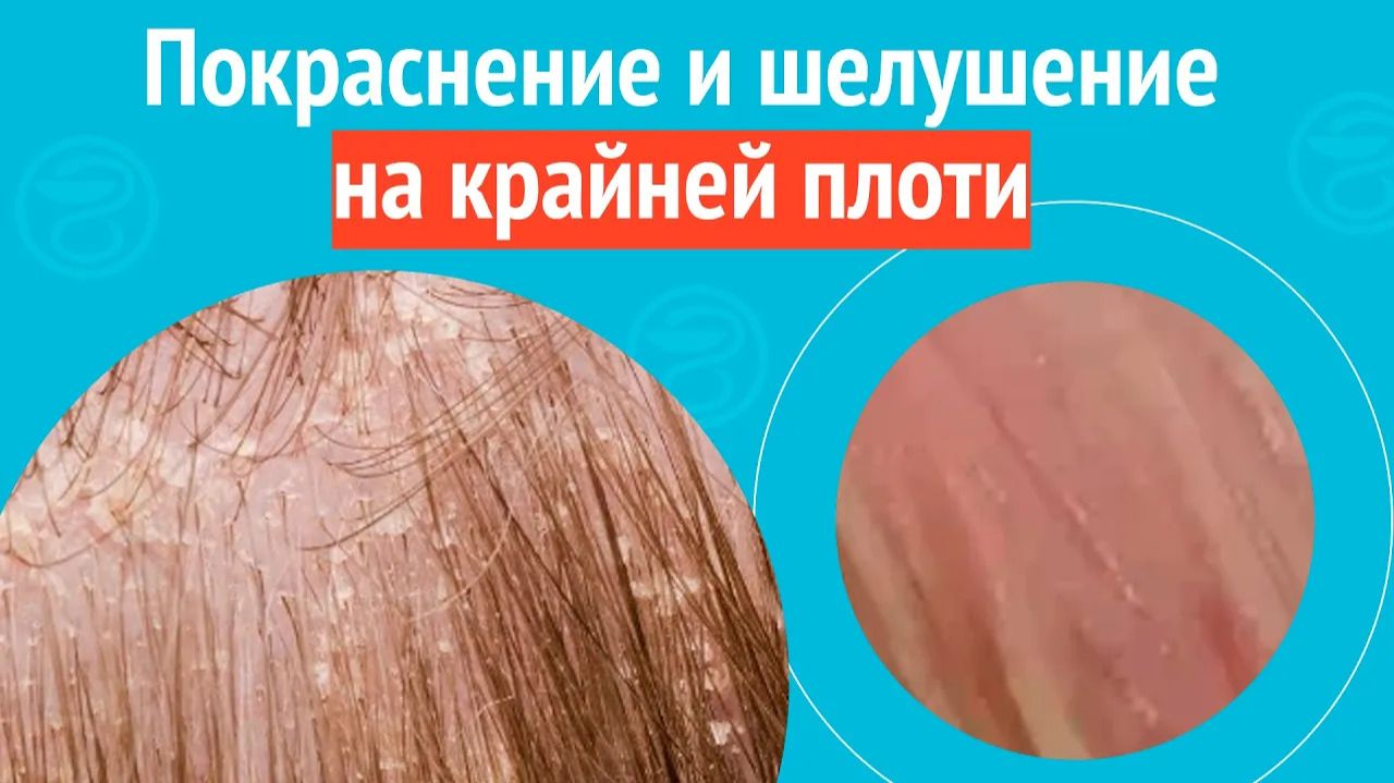 👉 Покраснение и шелушение на крайней плоти. Клинический случай №1559