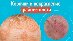 😡 Корочки и покраснение крайней плоти. Клинический случай №1564