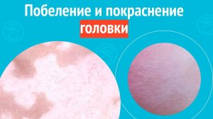 😡 Побеление и покраснение головки. Клинический случай №1546